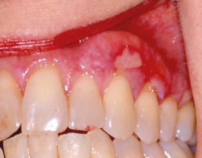 Oral Lichen Planus Cheek